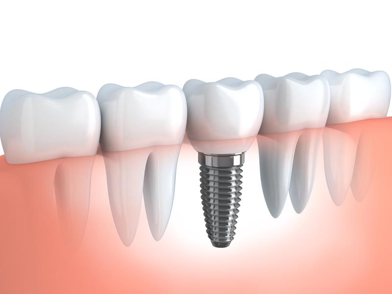 Dental Implants  Bellevue, WA 